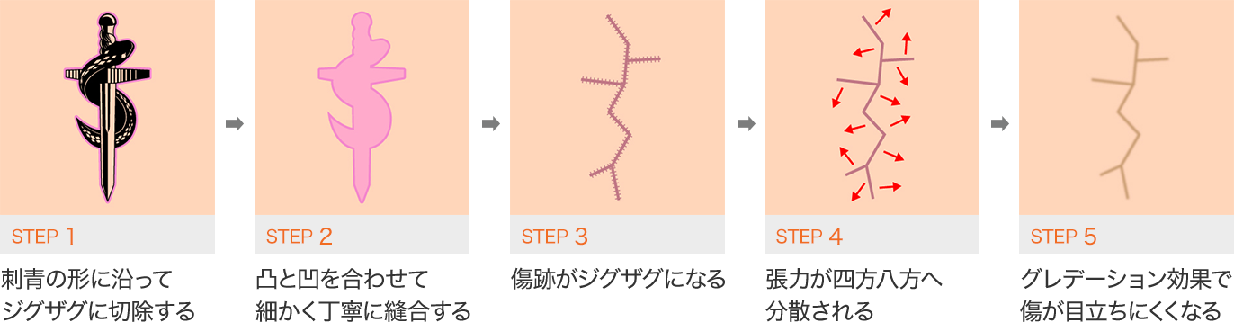 STEP1 刺青形に沿ってジグザグに切除する　STEP2 凸と凹に合わせて細かく丁寧に縫合する　STEP3 傷跡がジグザグになる　STEP4 張力が四方八方へ分散される　STEP5 グラデーション効果で傷が目立ちにくくなる