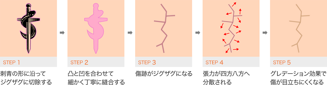 STEP1 刺青形に沿ってジグザグに切除する STEP2 凸と凹に合わせて細かく丁寧に縫合する STEP3 傷跡がジグザグになる STEP4 張力が四方八方へ分散される STEP5 グラデーション効果で傷が目立ちにくくなる