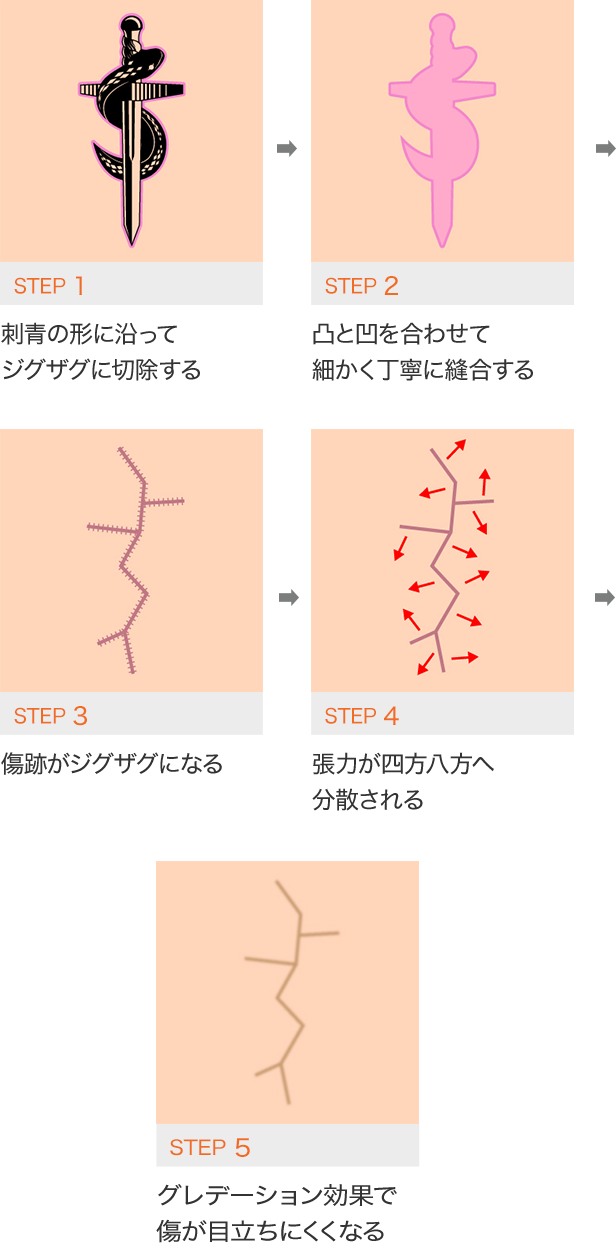 STEP1 刺青形に沿ってジグザグに切除する　STEP2 凸と凹に合わせて細かく丁寧に縫合する　STEP3 傷跡がジグザグになる　STEP4 張力が四方八方へ分散される　STEP5 グラデーション効果で傷が目立ちにくくなる